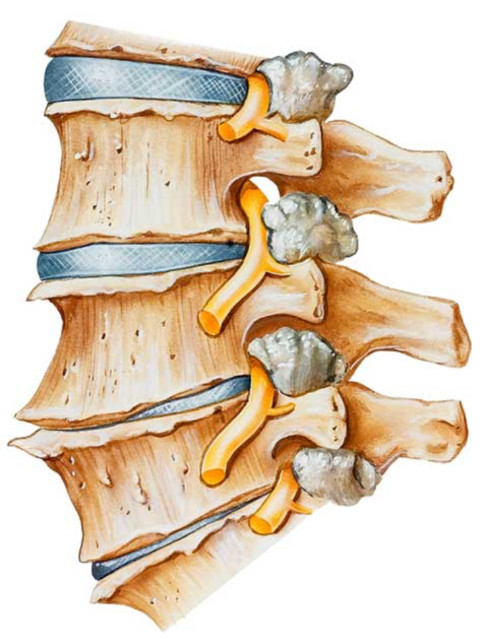 Lumbar osteoarthritis