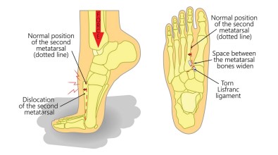Lis Franc Diagram