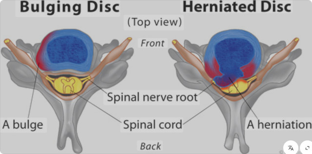 Lumbar disc herniation
