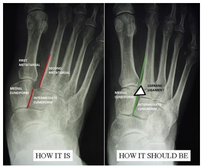 Lis Franc Xray