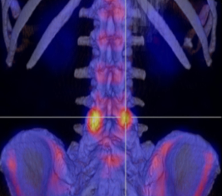 Lumbar stress.